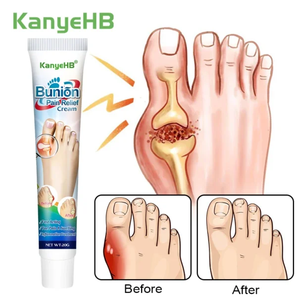 1Pcs Foot Gout Treatment Cream Thumb Corrector Finger Hallux Ointment Toe Bunion Pain Relieve Medical Plaster Health Care G019