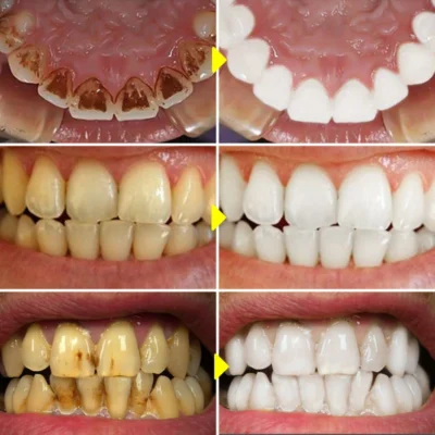 Teeth-Whitening-Essence-Remove-Against-Dental-Caries-Plaque-Stains-Serum-Fresh-Breath-Oral-Hygiene-Dental-Tooth-3